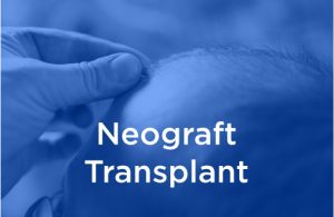 Neograft transplant