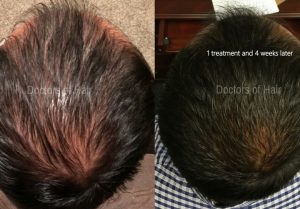 before and after prp