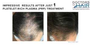 prp hair